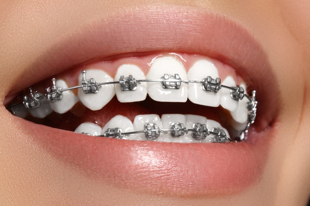 Эстетические брекеты для выравнивания зубов
