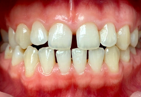 Имплантация нижней челюсти — фото до установки импланта