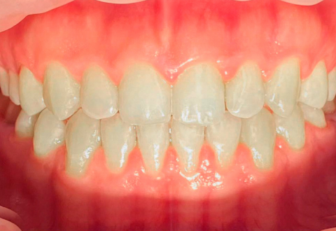 Имплантация нижней челюсти — фото после установки импланта