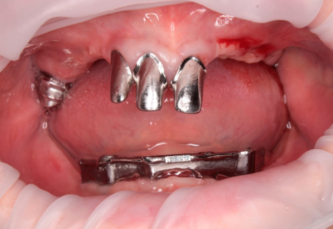 Реконструкция нижней челюсти с несъемным протезированием - фото до