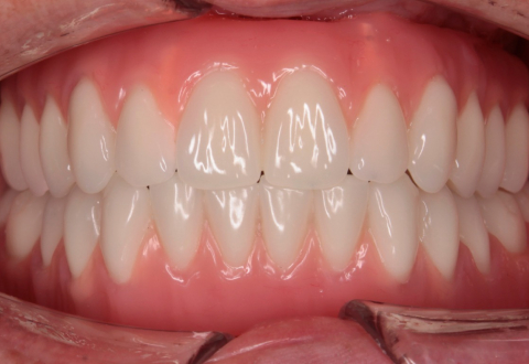 Реконструкция нижней челюсти с несъемным протезированием - фото после