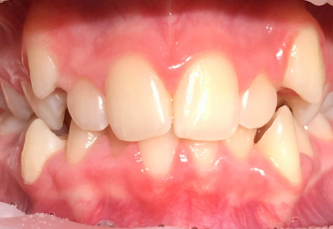 Реконструкция зубного ряда нижней челюсти с помощью имплантов до