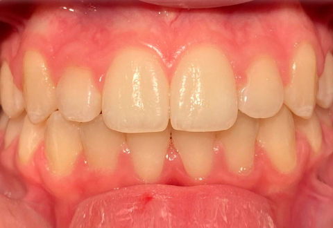 Реконструкция зубного ряда нижней челюсти с помощью имплантов после