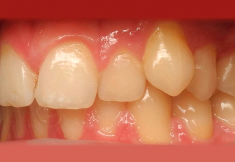 Установка зубного импланта на нижнюю челюсть — результат лечения до