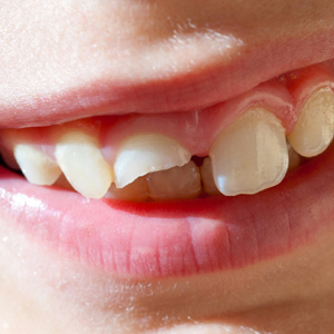 Рекомендации в период восстановления после имплантации зубов
